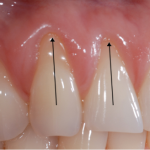gum recession thumbnail